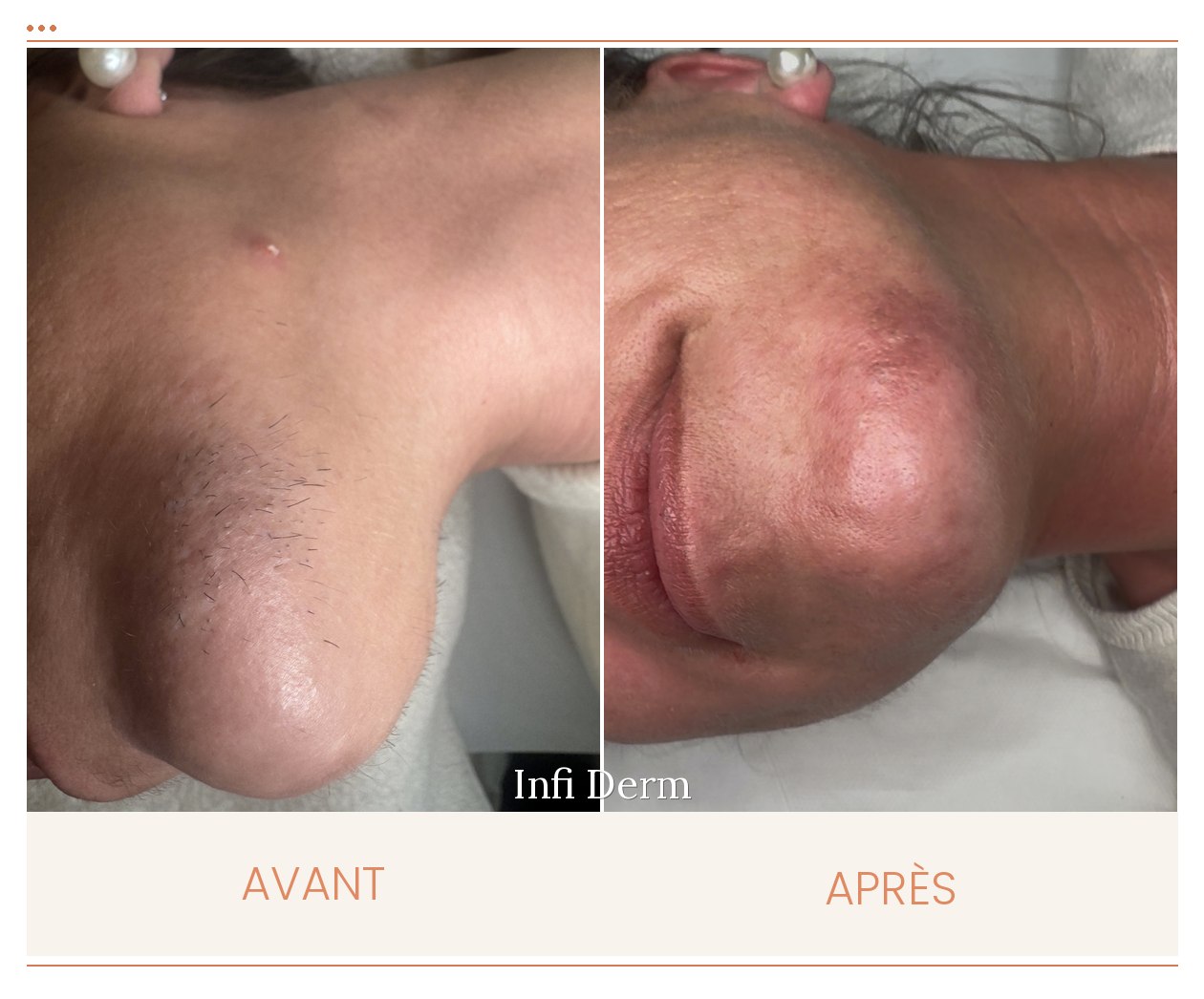 Avant après d'une cure d'électrolyse : pilosité visiblement réduite poil par poil