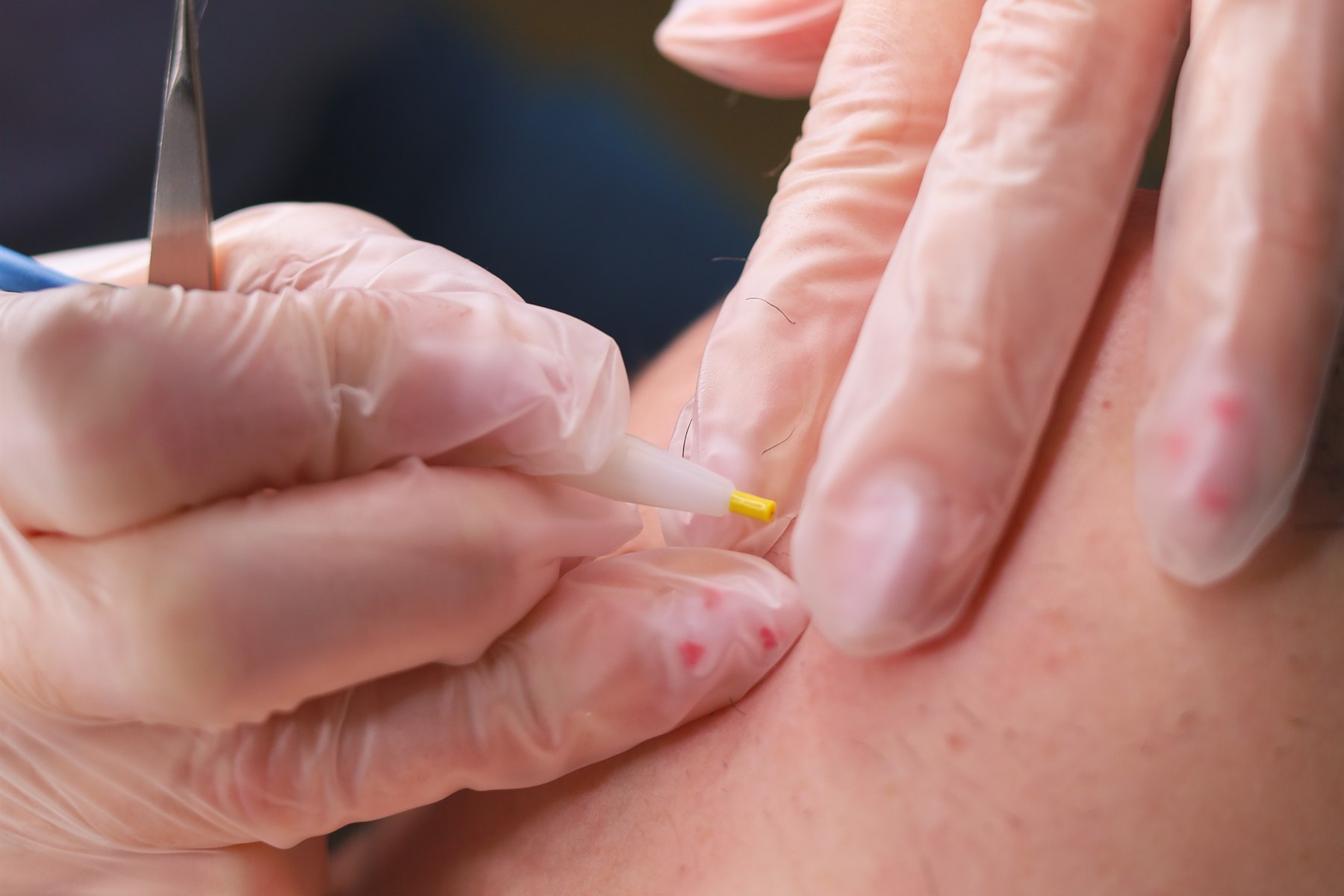 Séance d'épilation définitive par électrolyse à Caen, Infi Derm