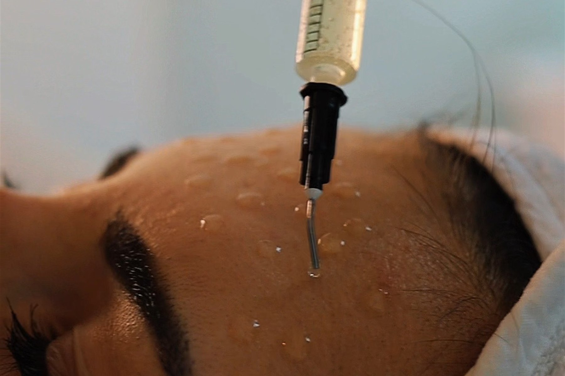 Application du peeling biorevitalisant PRX-T33 en cabine à Caen, Infi Derm