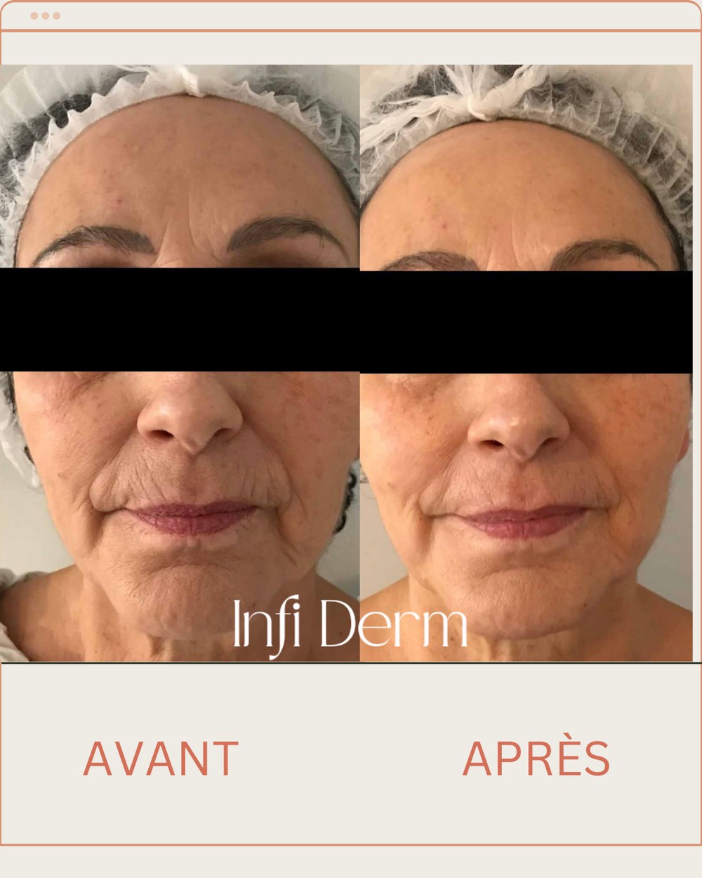 Avant après d'un soin Jet Peel du visage : peau plus lisse et teint unifié