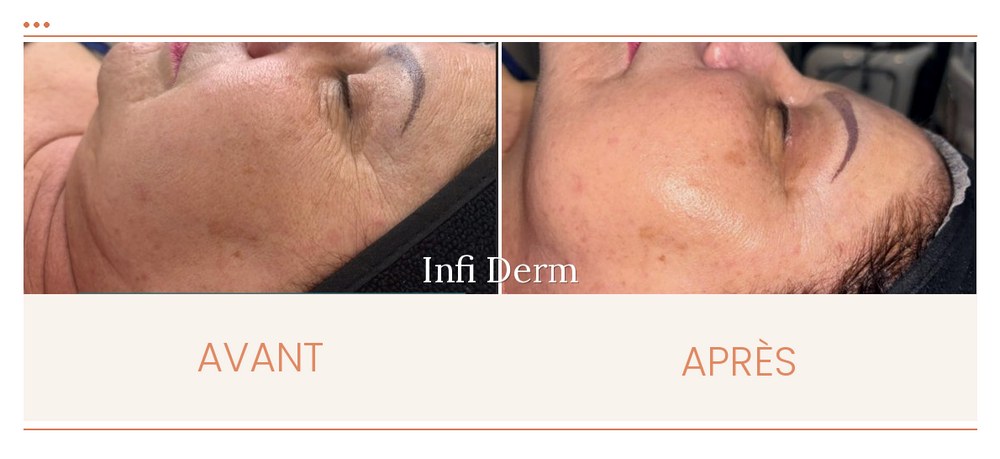 Avant après d'un Jet Peel anti-âge : peau lissée et ridules atténuées