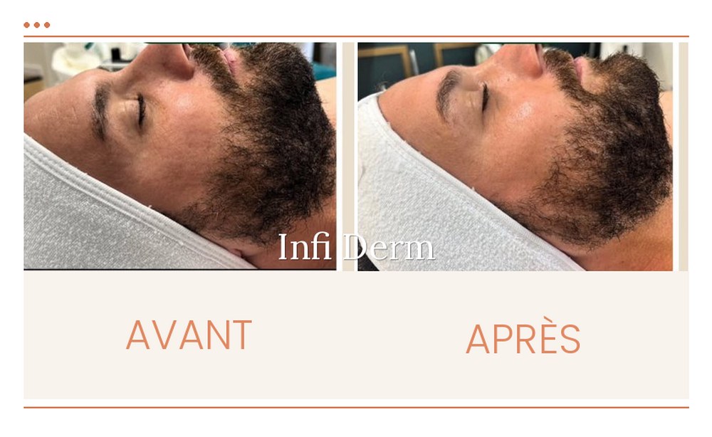 Avant après d'un Jet Peel pour homme : grain de peau affiné, teint plus net