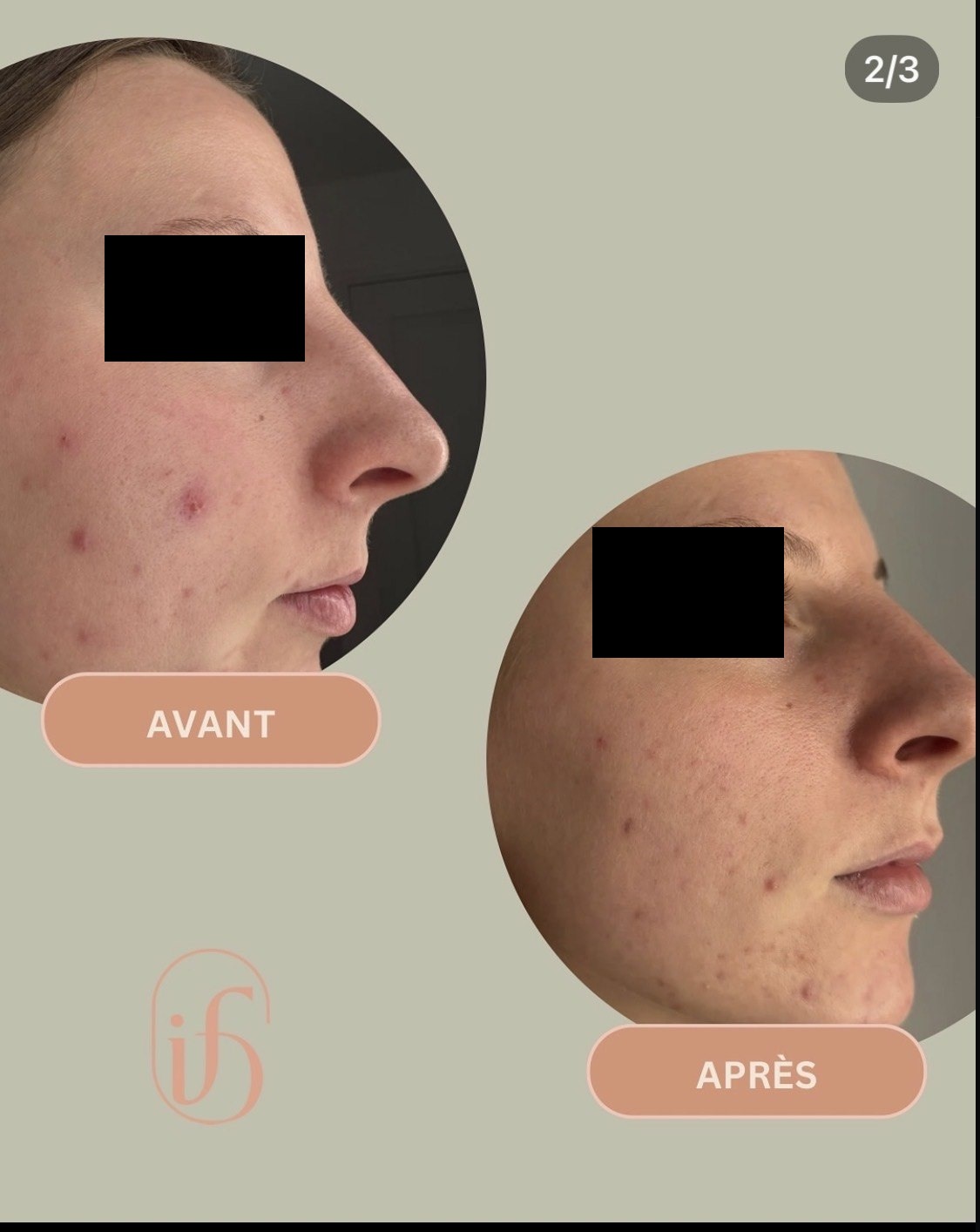 Avant après d'une cure de LED médicale sur peau à tendance acnéique : profil avec lésions apaisées