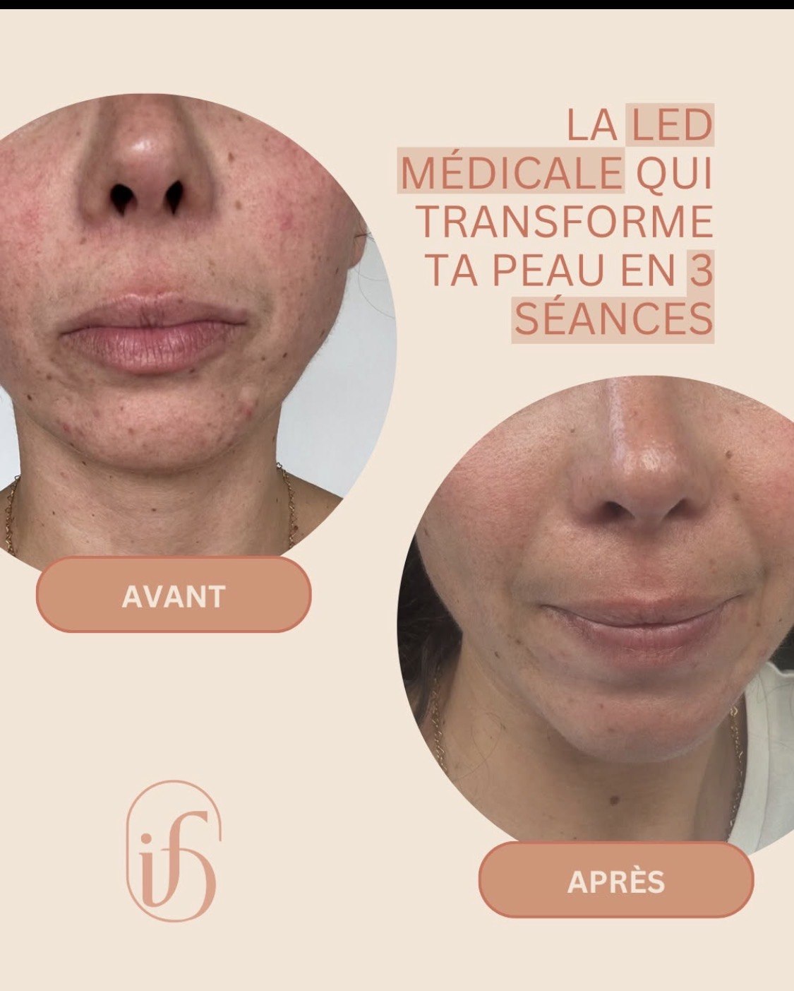 Avant après d'une cure de LED médicale : peau plus uniforme et inflammations apaisées