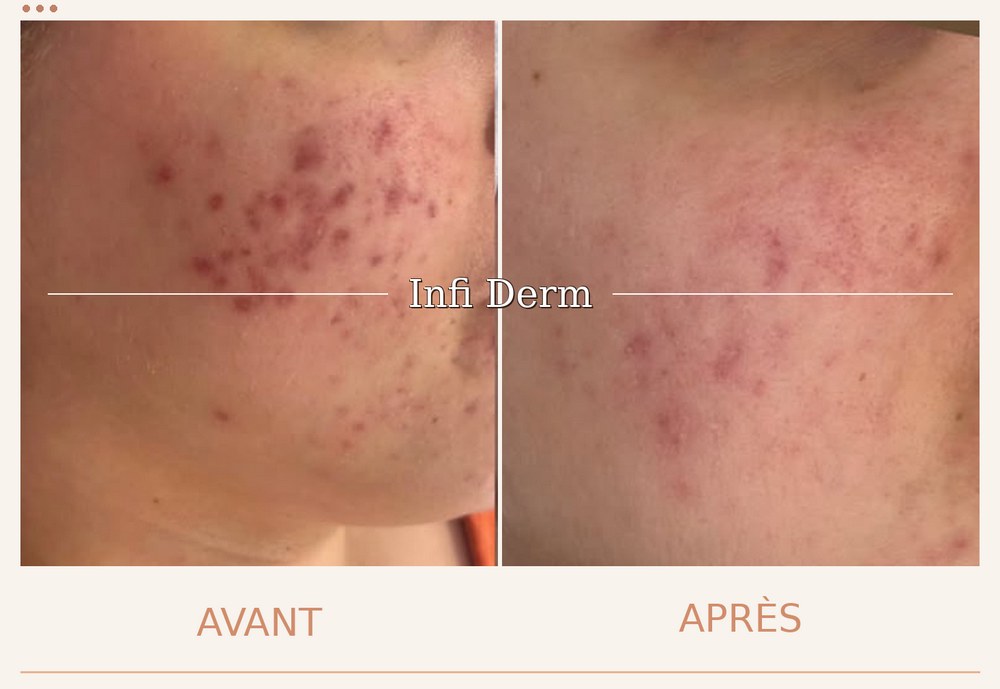 Avant après d'un soin LED sur une peau acnéique : inflammation et rougeurs apaisées