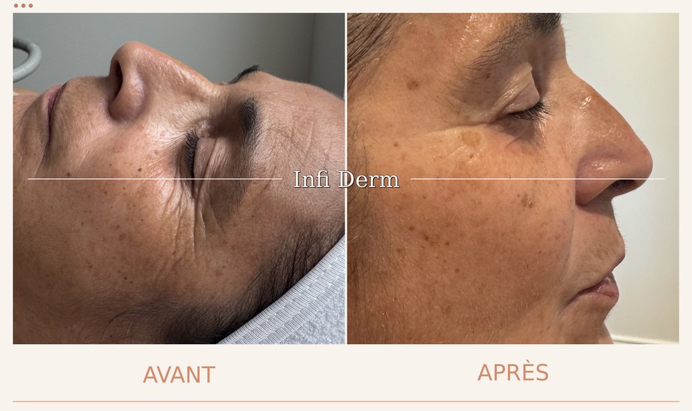 Avant après d'un peeling : taches atténuées et peau visiblement lissée