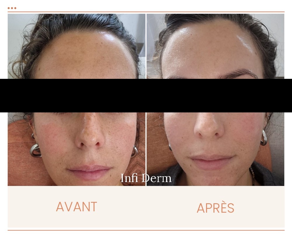 Avant après d'un peeling du visage : teint unifié et grain de peau lissé